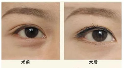 割双眼皮切开法