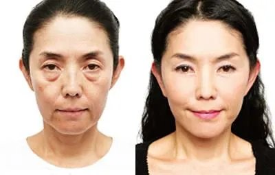 玻尿酸注射除皱好吗