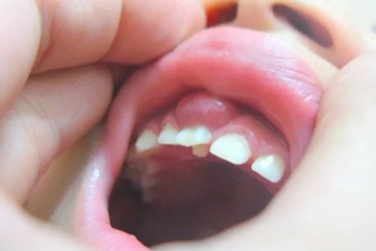 牙槽脓肿症状图片