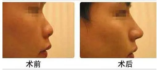 硅胶假体隆鼻价格