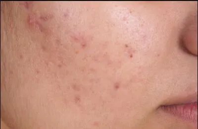 做祛痘需要多少钱？费用是多少？