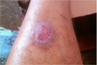 疽是什么样子的图片