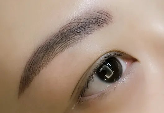 埋线重睑术后注意什么