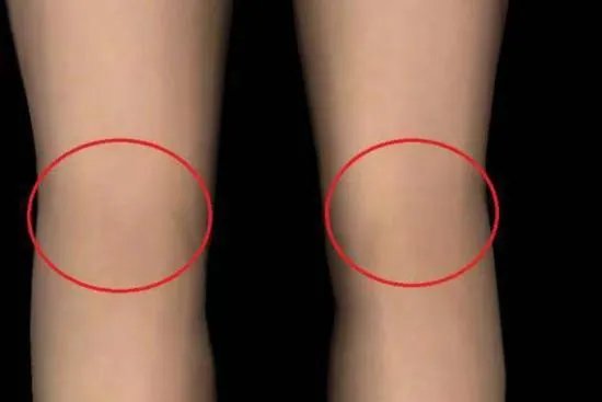 腘窝的准确位置图