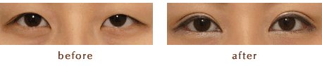 高分子埋线双眼皮多少钱