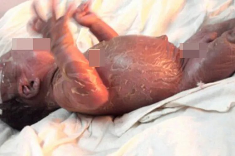 鱼鳞病全身脱皮图片