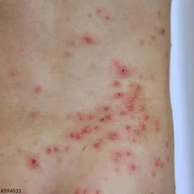 为什么经常得单纯疱疹