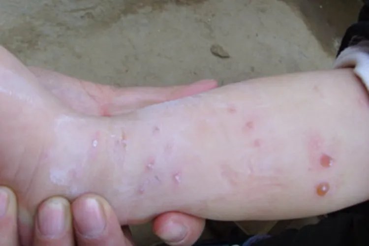 脓疱疮症状图片