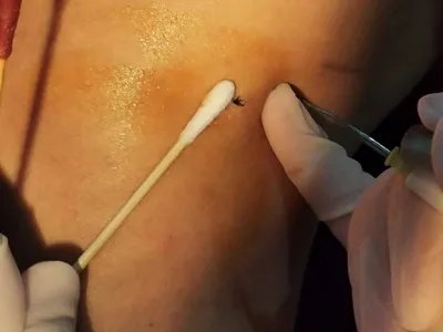 皮脂腺囊肿肿块图片