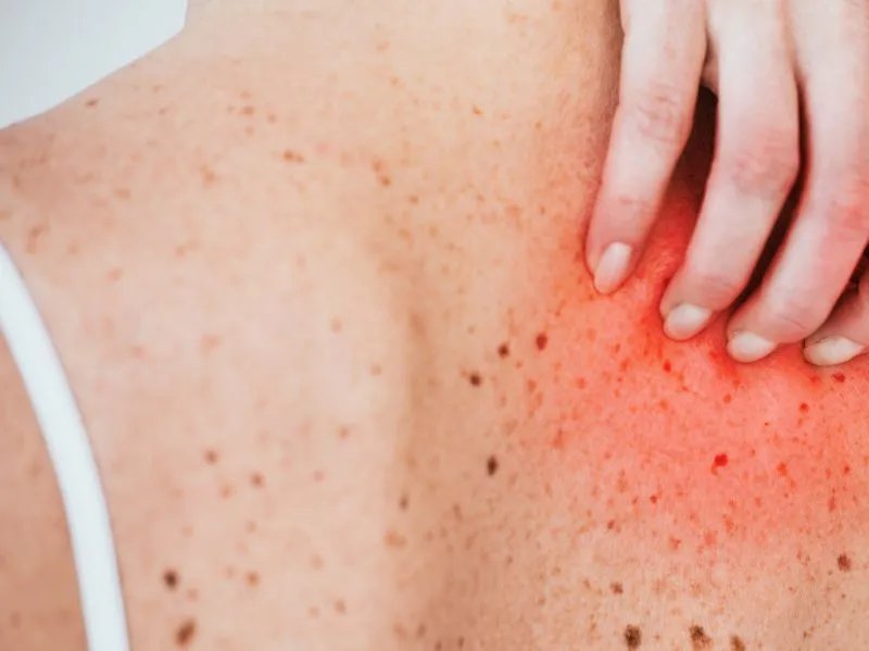 新生儿荨麻疹的症状