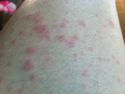 特发性嗜酸性粒细胞增多综合征大腿小红疙瘩图片