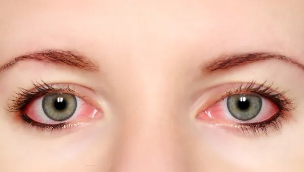 什么是三点定位双眼皮