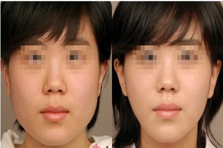 瘦脸针一周变化图