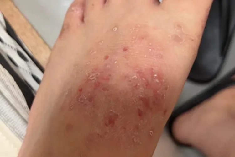 足癣脚背糜烂图片