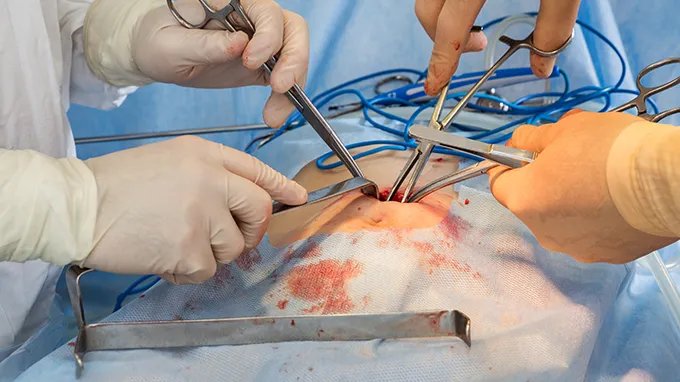 gist胃肠道间质瘤严重吗