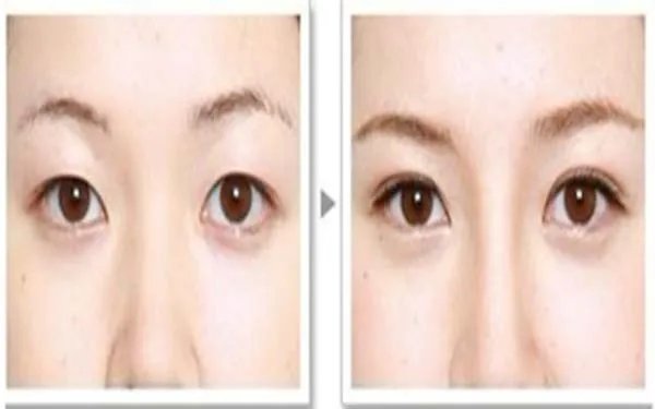 北京埋线双眼皮整形哪个医院好？