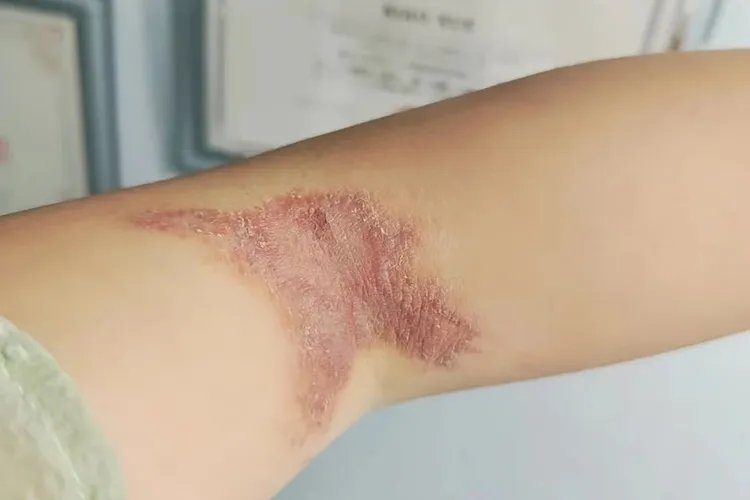 被隐翅虫咬后恢复过程图