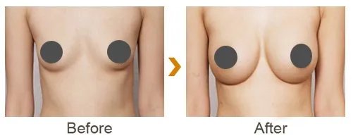 北京自体脂肪隆胸手术价格大概是多少