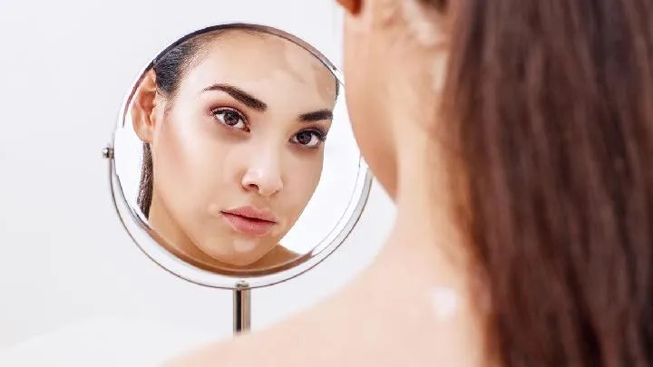 白癜风的治疗方法有哪些