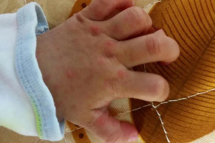 手足口病症状初期图片，痒不痒