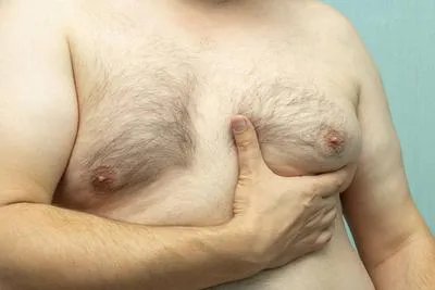 如何治疗男性乳房发育症