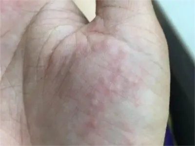 典型麻疹出疹期症状图片