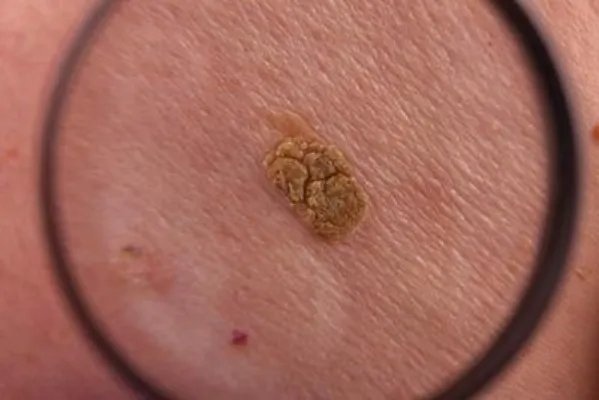 治疗疮疡肿毒用什么药