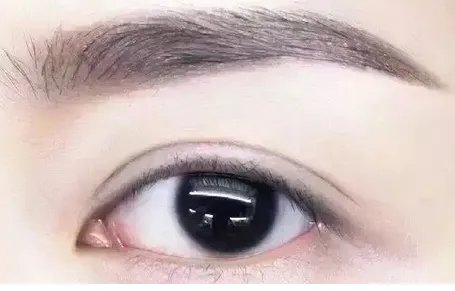 做双眼皮开眼角坏处