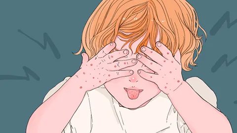 冬天冻手了怎么办