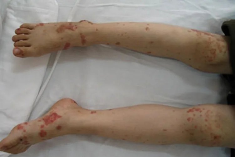 紫癜图片和症状