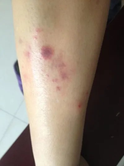 过敏性紫癫有什么症状?