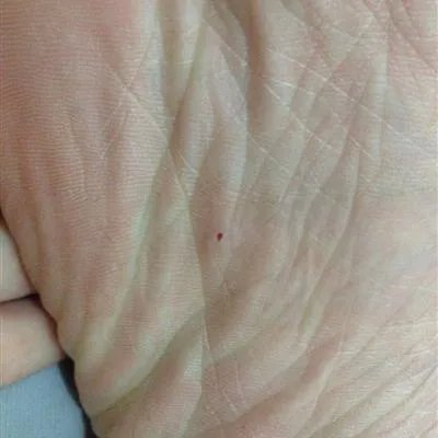 应该怎么样治疗皮角呢