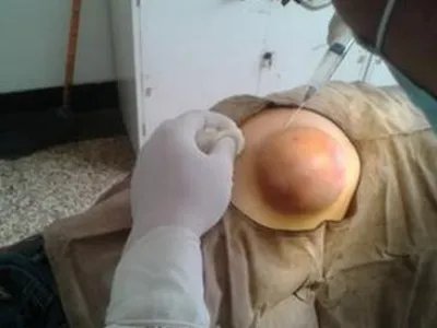 皮脂腺囊肿肿块图片