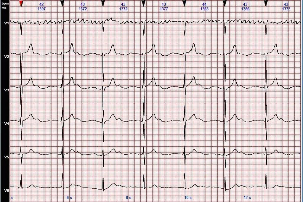 正常心电图图片