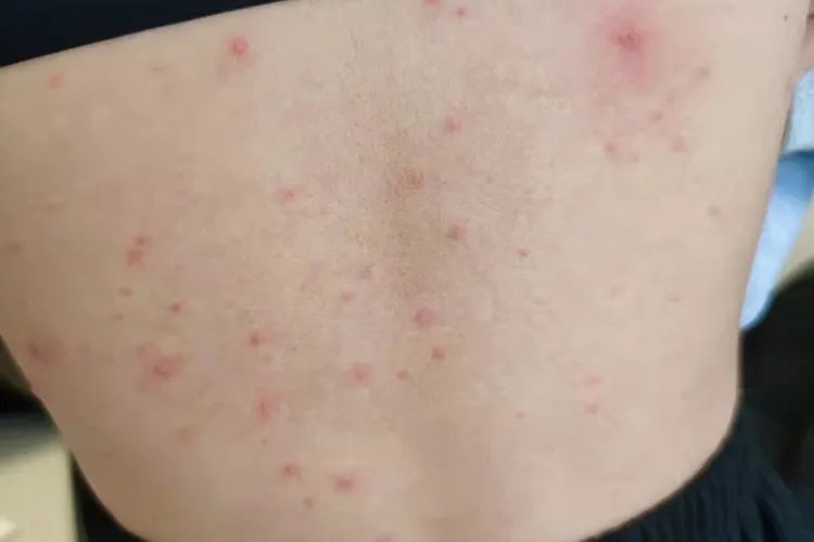 起水痘是什么样的图片