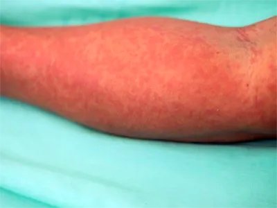 典型麻疹出疹期症状图片