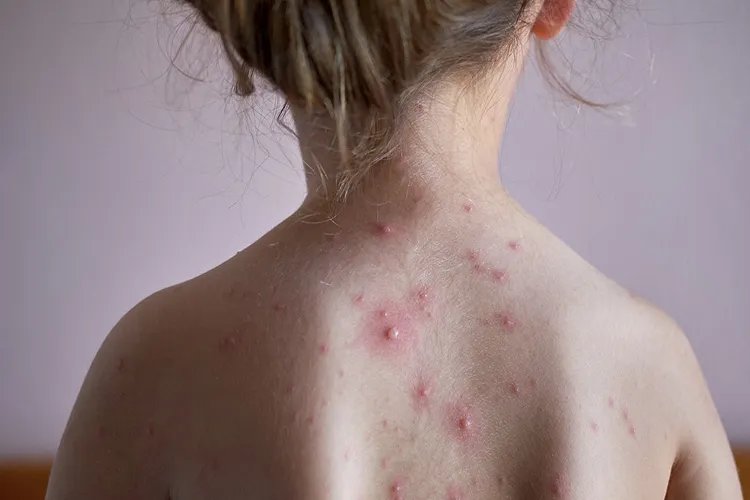 水痘初期症状图片,水痘一般年龄