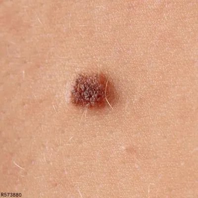 痣有什么危害 了解痣的两个危害