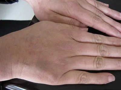 典型麻疹出疹期症状图片