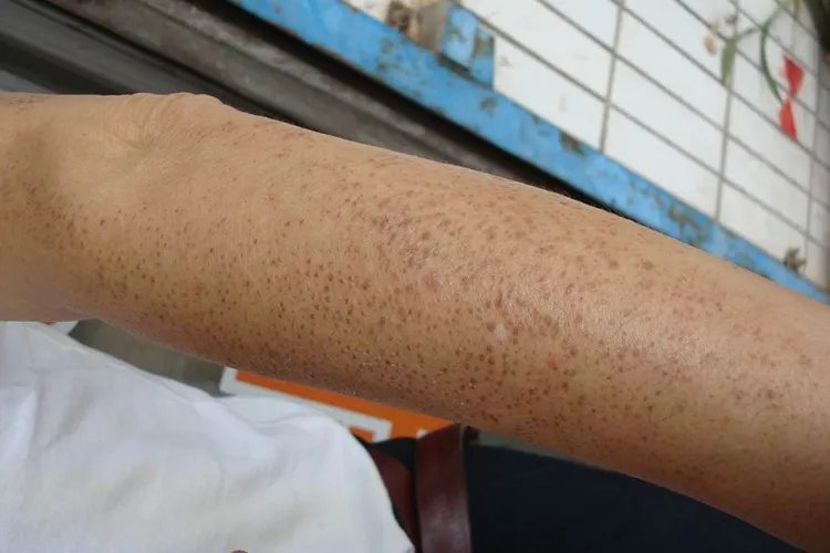 毛周角质化是什么样