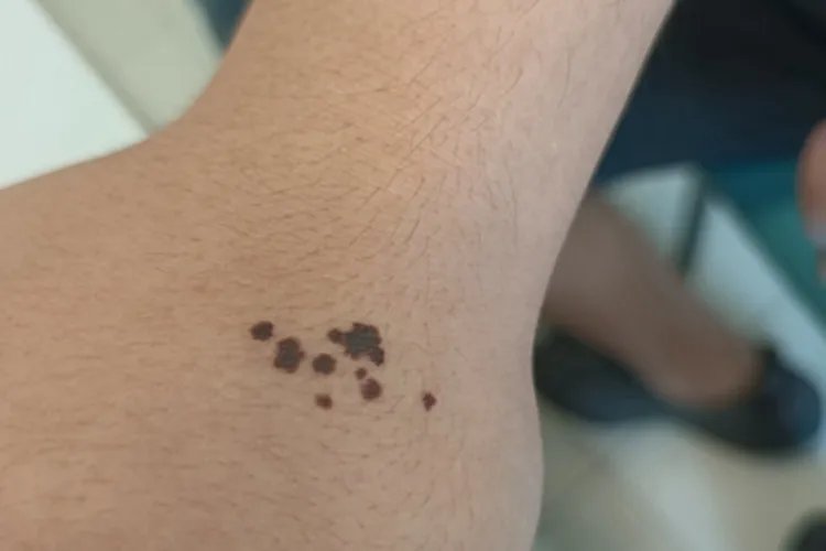 斑痣手背症状图片