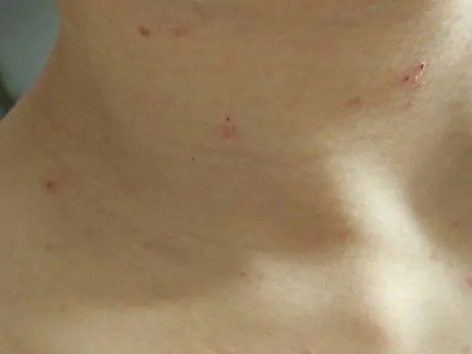 过敏性紫癫有什么症状?