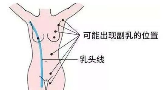 多乳症是由什么原因造成的呢？