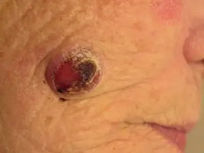 鲍温病面部症状图片