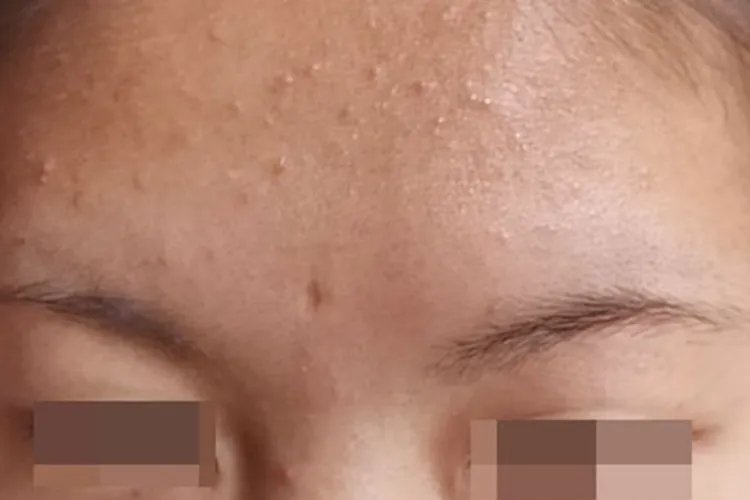 痤疮白头粉刺图片