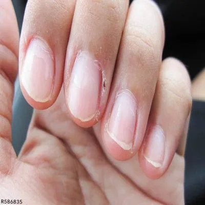 指甲呈白色是正常的吗 指甲呈白色暗示2个隐疾