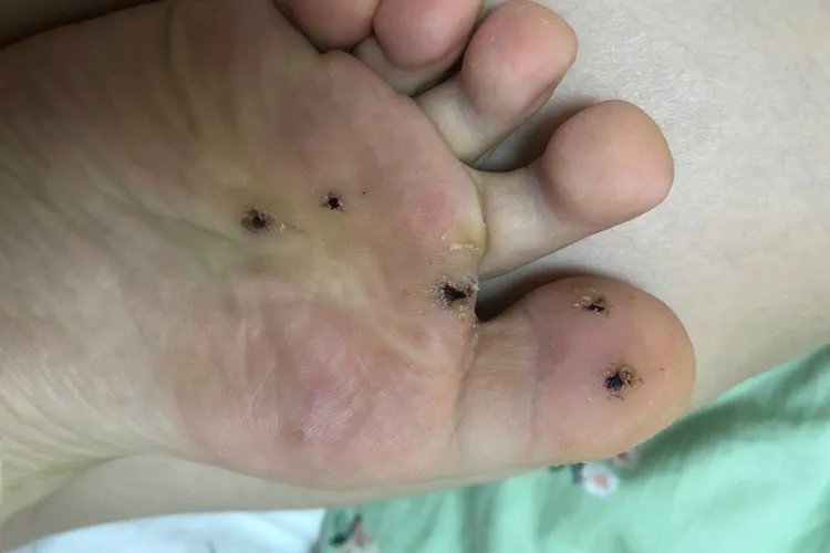 前脚掌肉刺图片