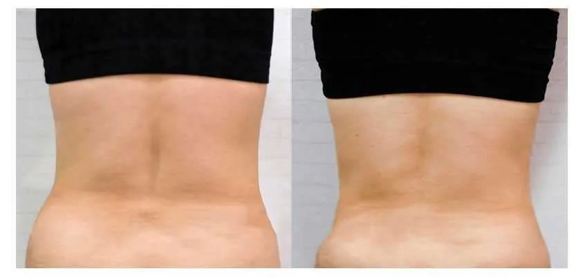 背部吸脂减肥价格