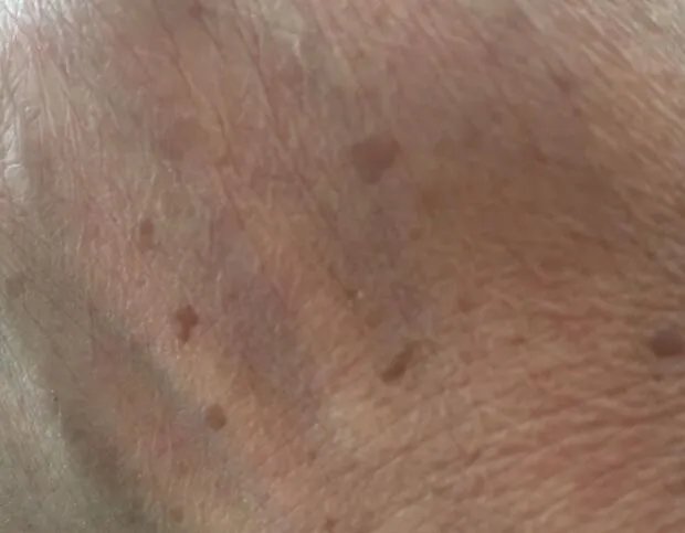 老年斑图片对比