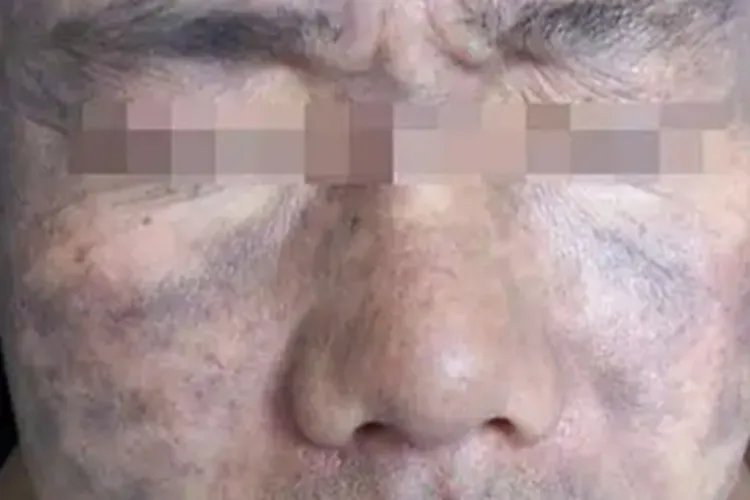 皮肤黑变病症状图片